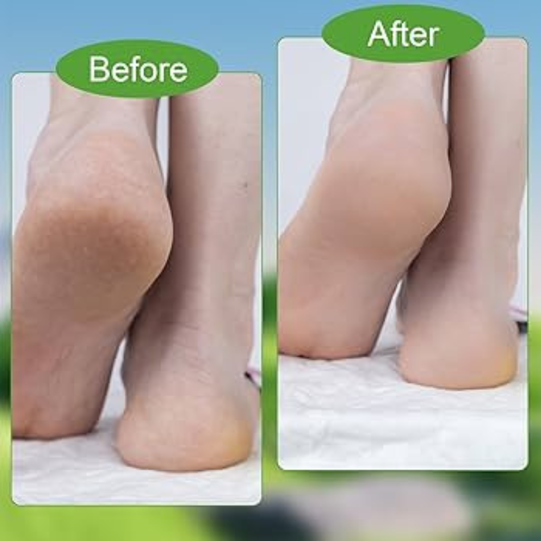Rozino Tea Tree Oil Foot & Damage Skin Repair Cream | Vitamin E, Aloe Vera & Peppermint | Repairs Cracked Heels, Dry Feet & Rough Skin