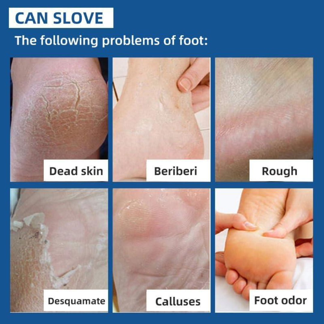Rozino Tea Tree Oil Foot & Damage Skin Repair Cream | Vitamin E, Aloe Vera & Peppermint | Repairs Cracked Heels, Dry Feet & Rough Skin