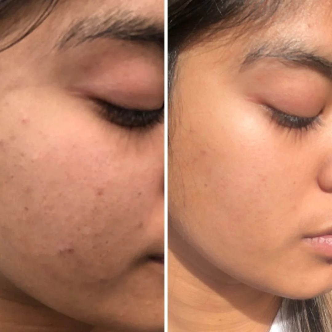 RELUMINS Luminous UltraGlow Toner – 50% OFF – Whitening & Oil Reducing – Brightens Skin Tone, Controls Excess Oil, Refines Pores – Evens Skin Tone, Smooths Texture – Gentle, Refreshing