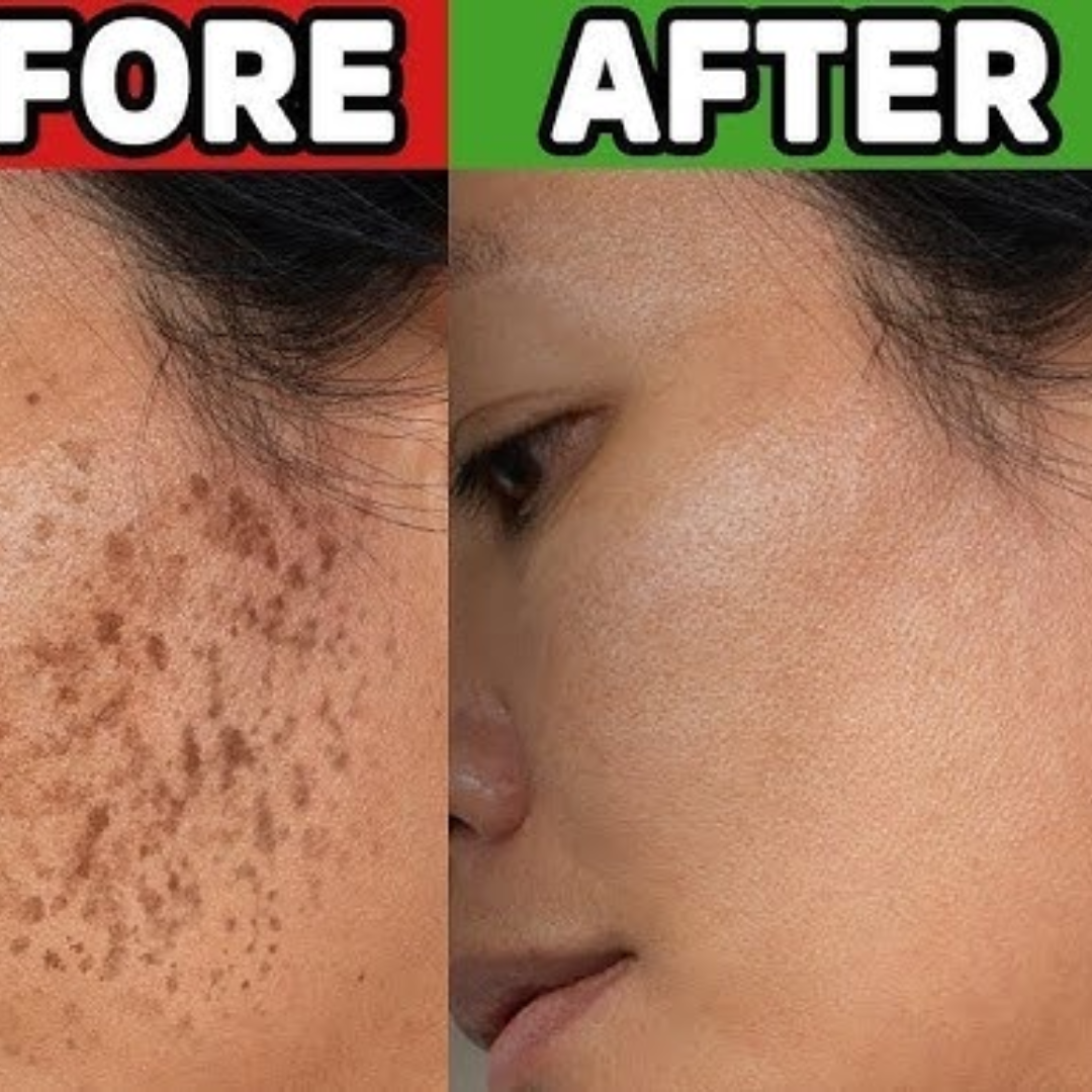 Skin ResQ Brightening Cream | #1 Bestselling Formula with Alpha Arbutin, Niacinamide & Vitamin C | Fades Hyperpigmentation, Dark Spots & Acne Marks