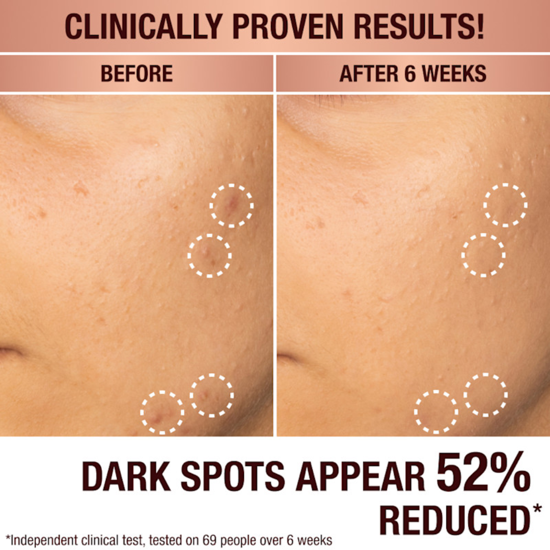 Skin ResQ Brightening Cream | #1 Bestselling Formula with Alpha Arbutin, Niacinamide & Vitamin C | Fades Hyperpigmentation, Dark Spots & Acne Marks