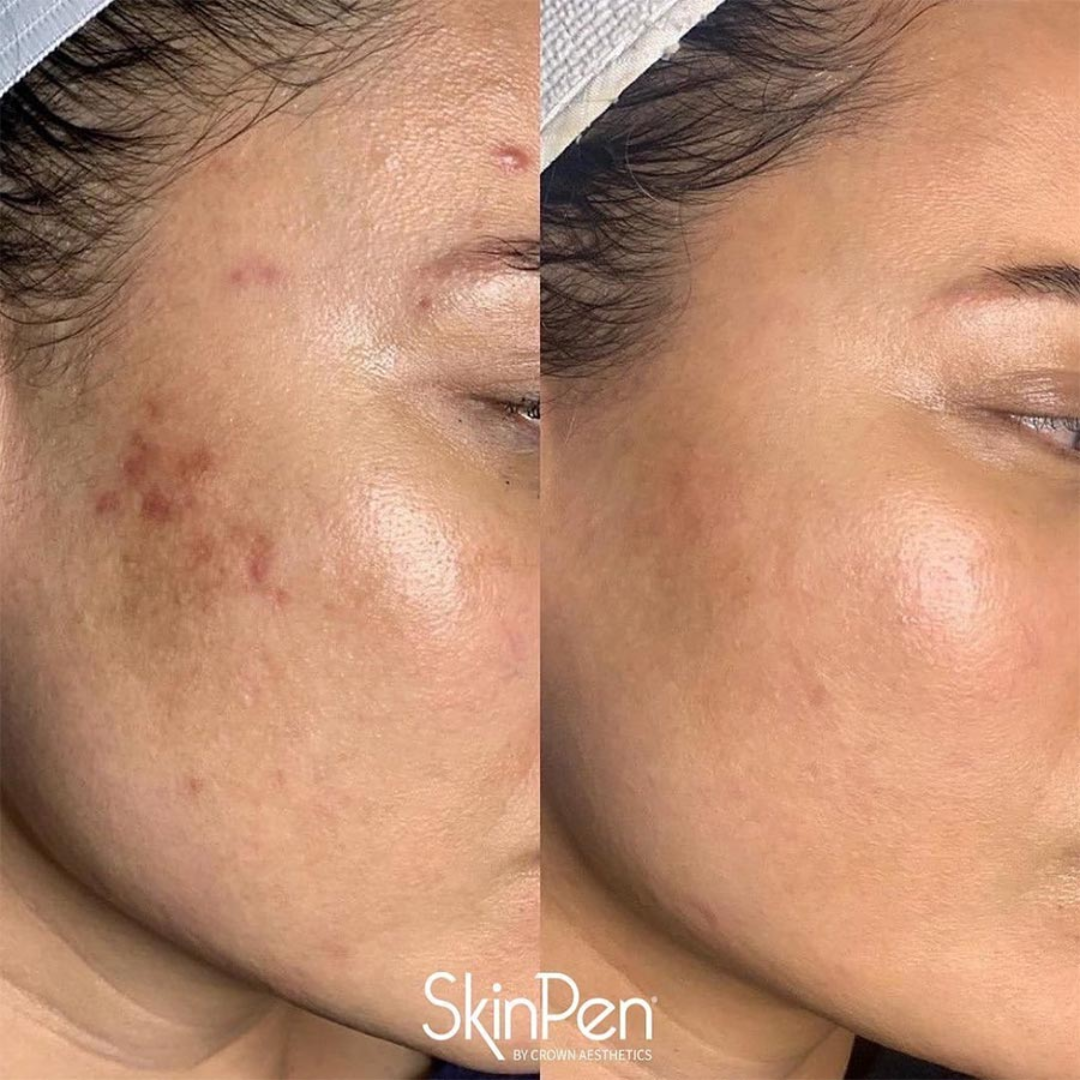 Skin ResQ Brightening Cream | #1 Bestselling Formula with Alpha Arbutin, Niacinamide & Vitamin C | Fades Hyperpigmentation, Dark Spots & Acne Marks
