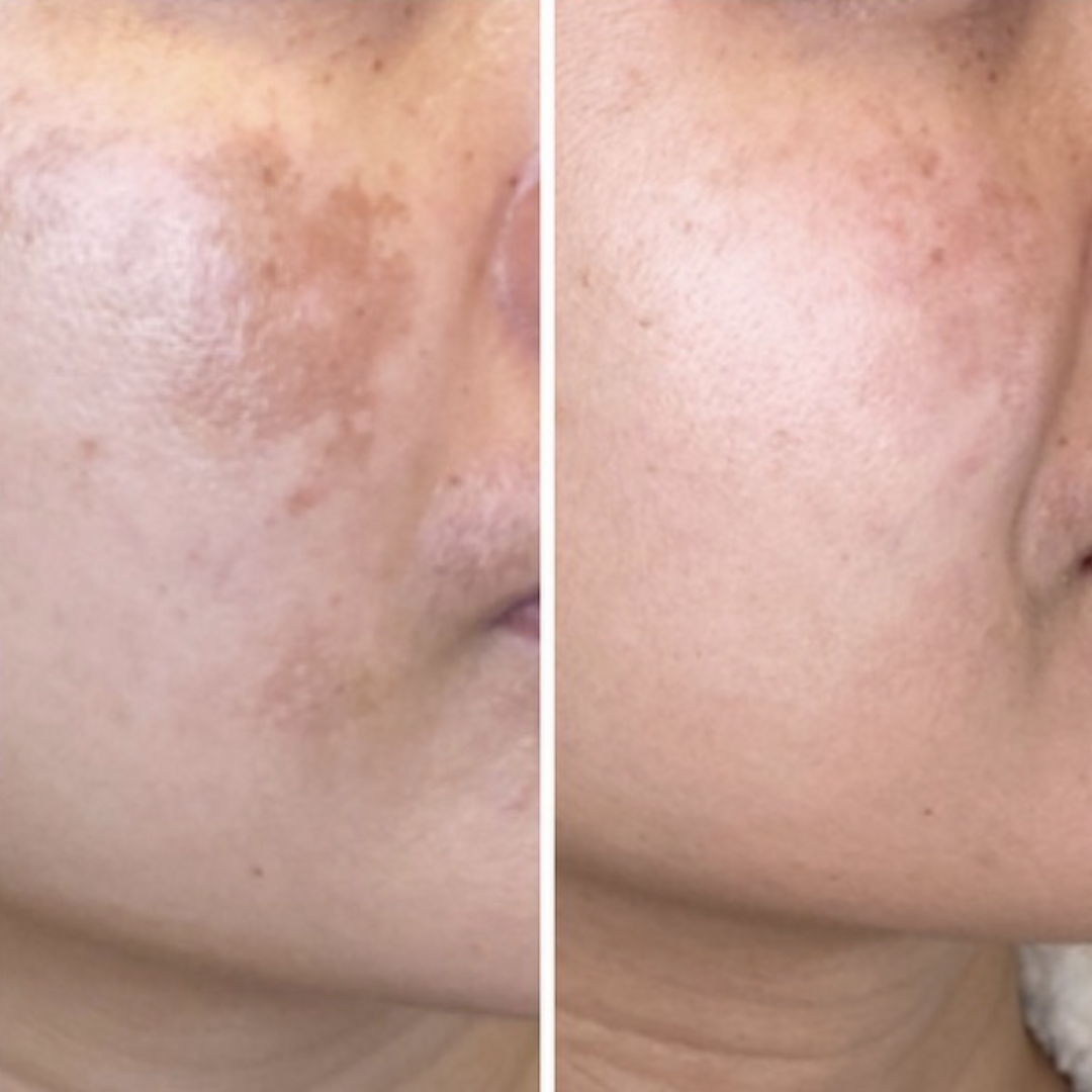 Skin ResQ Brightening Cream | #1 Bestselling Formula with Alpha Arbutin, Niacinamide & Vitamin C | Fades Hyperpigmentation, Dark Spots & Acne Marks