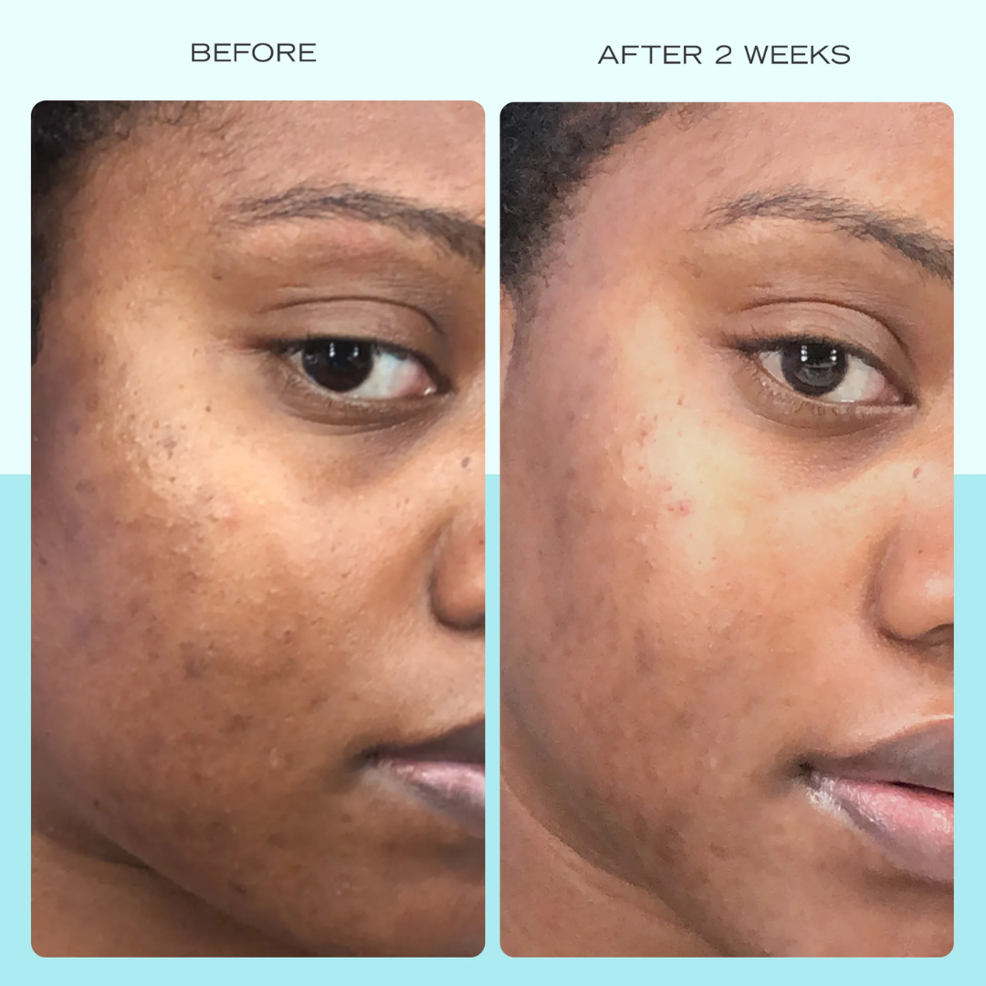 Skin ResQ Brightening Cream | #1 Bestselling Formula with Alpha Arbutin, Niacinamide & Vitamin C | Fades Hyperpigmentation, Dark Spots & Acne Marks