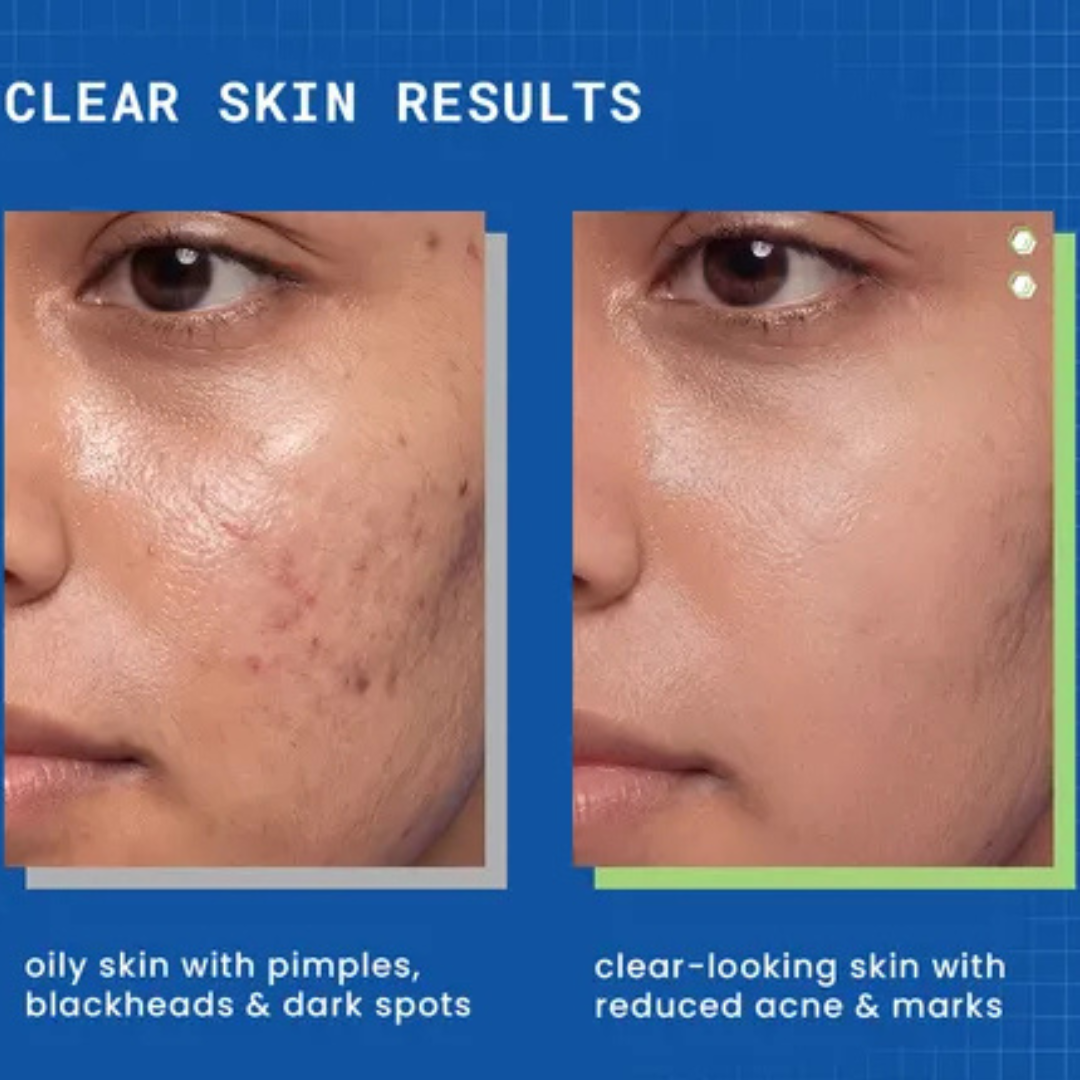 Skin ResQ Brightening Cream | #1 Bestselling Formula with Alpha Arbutin, Niacinamide & Vitamin C | Fades Hyperpigmentation, Dark Spots & Acne Marks