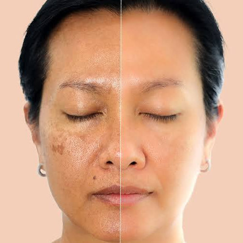 Teashell Niacinamide Brightening Serum – Targets Melasma, Dark Spots & Freckles – Brightens & Evens Skin Tone, Improves Texture & Radiance – For All Skin Types